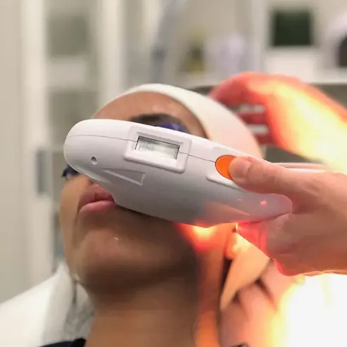 IPL Skin Rejuvenation