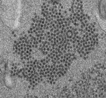 Descubren Anticuerpos que actúan contra Enterovirus en Pacientes con Mielitis Flácida Aguda