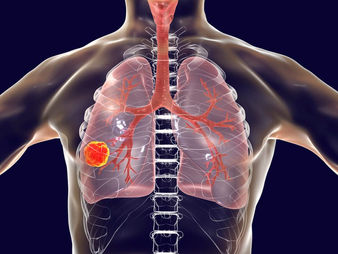 Tuberculosis, Causa de Muerte de Hasta mil Millones de Personas en Cien Años
