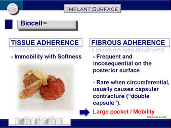 Allergan retira del mercado sus implantes mamarios Biocell a Nivel Mundial ¿la causa? linfoma anaplá