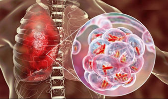 Las nuevas recomendaciones de la OMS para prevenir la tuberculosis