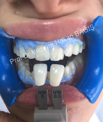 beyazlatma bleaching