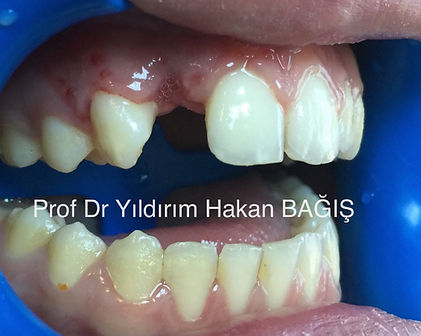 kompozit köprü bridge