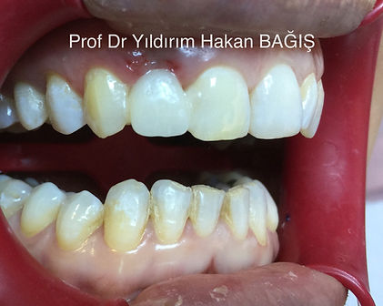 kompozit köprü bridge