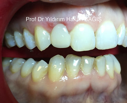 kompozit köprü bridge