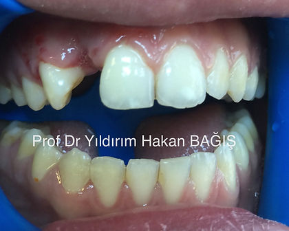 kompozit köprü bridge