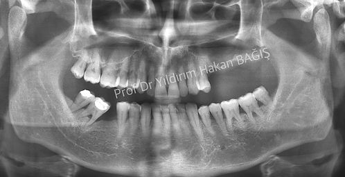 sinüs yukarı alma lifting