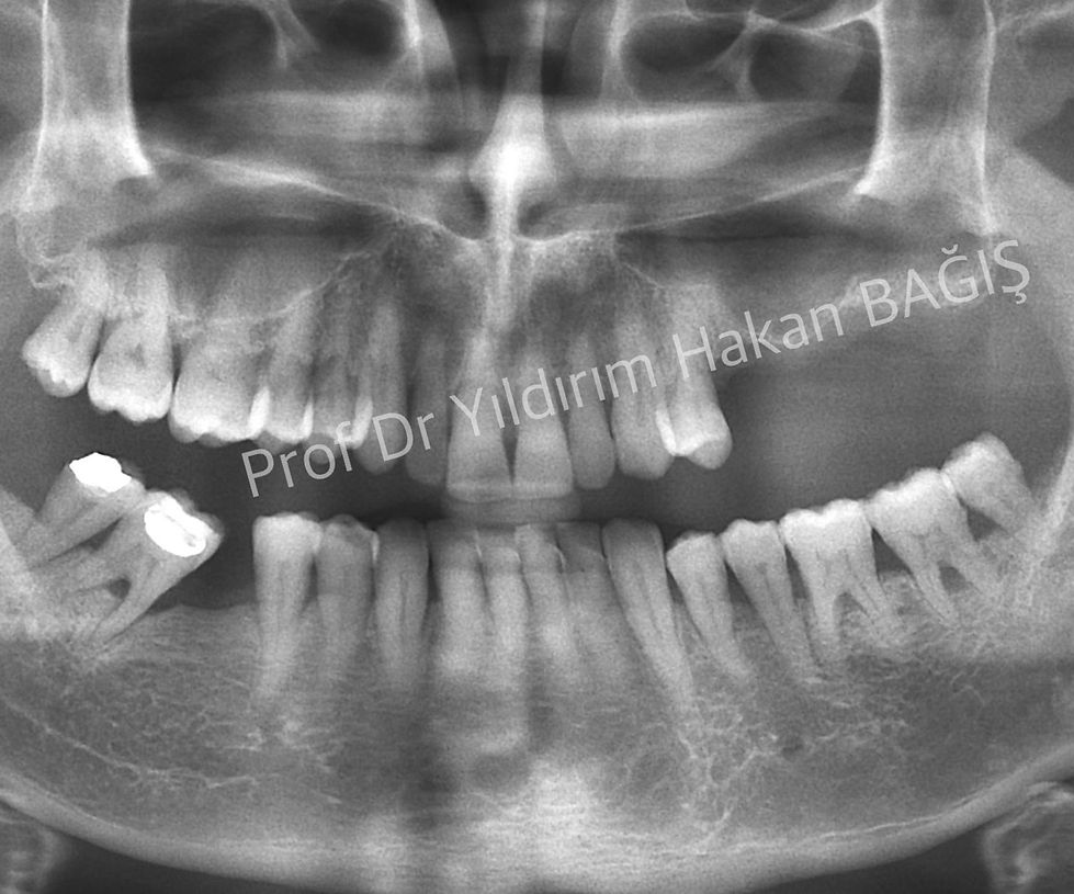 sinüs yukarı alma lifting