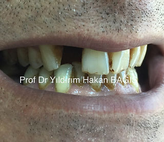 kompozit köprü bridge