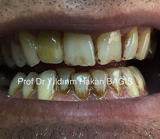 kompozit köprü bridge