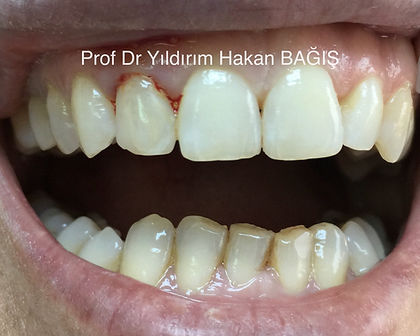 kompozit köprü bridge