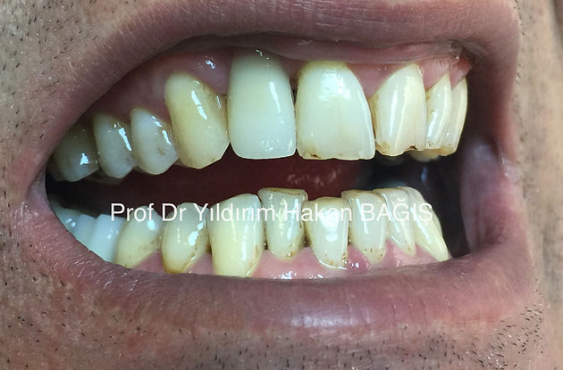 kompozit köprü bridge