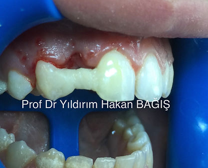 kompozit köprü bridge