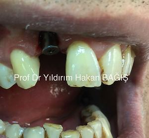 kompozit köprü bridge