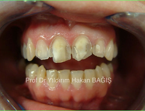 porselen, seramik ceramic laminate lamineyt