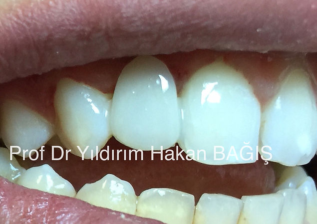 kompozit köprü bridge