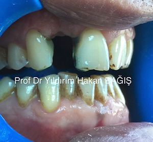 kompozit köprü bridge