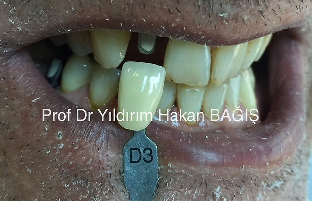 kompozit köprü bridge