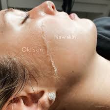 Dermaplaning Before and After