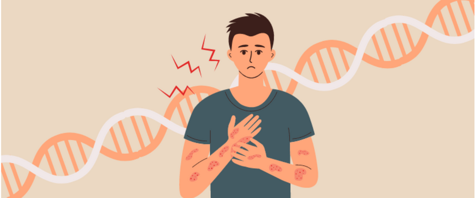 The Blueprint of Skin Health—Genetics, Eczema, and Psoriasis