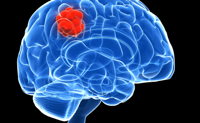 AI and Cancer Diagnoses