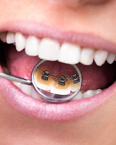 Lingual-Braces.jpeg