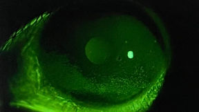 Valutare l'Occhio Secco