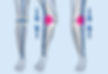 Knee Misalignment