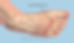 metatarsalgia