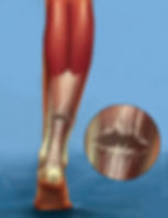achilles-tendon