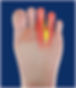 morton-neuroma