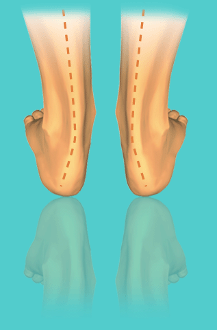 footproblem_main_pronation