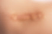 Ar efter forbrændinger og operationer | Apex Health & Aesthetics