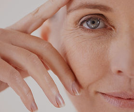 Radiesse wrinkle treatment