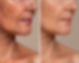 Cosmelan | Apex Health & Aesthetics