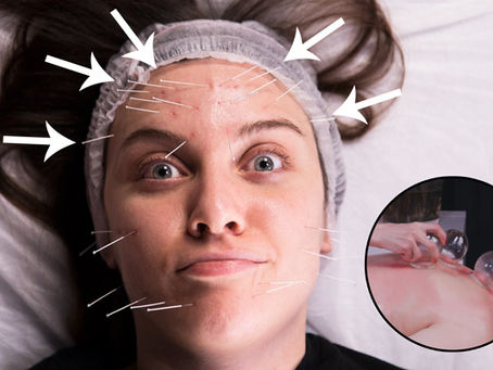 Çin Tıbbı Yöntemlerini Denedim