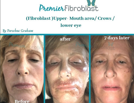 Fibroblast Treatment | Premier Fibroblast