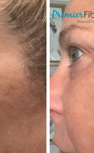Premier Fibroblast San Diego Fibroblast Skin Tightening