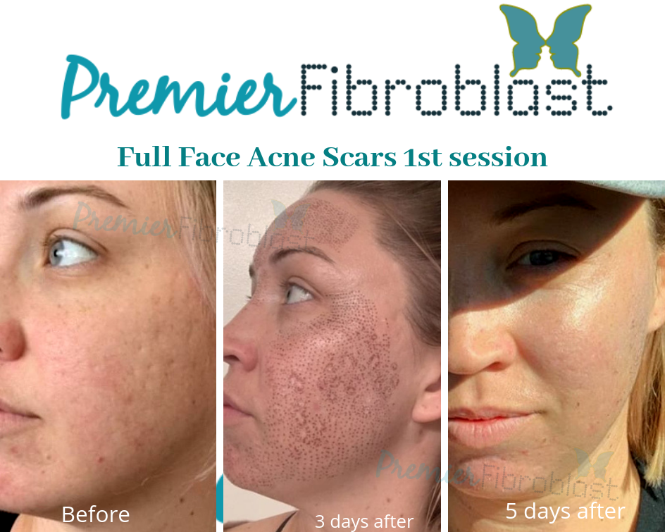 Why Fibroblast’s Treatment Eliminates the Need For Traditional Skin Tightening 