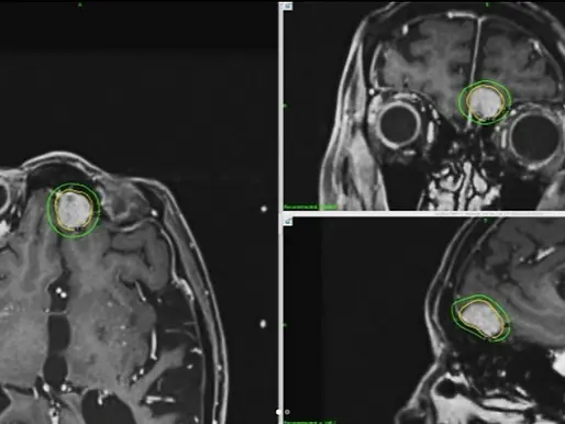 Brain tumour- Meningioma
