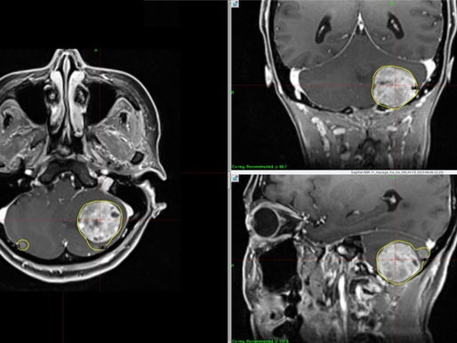Almost complete response post Gamma Knife Radiosurgery for brain metastasis
