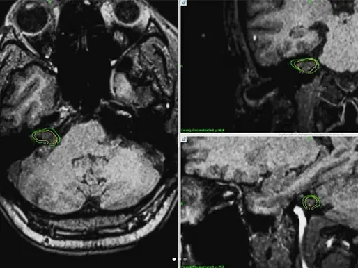 Brain tumour- Acoustic Neuroma