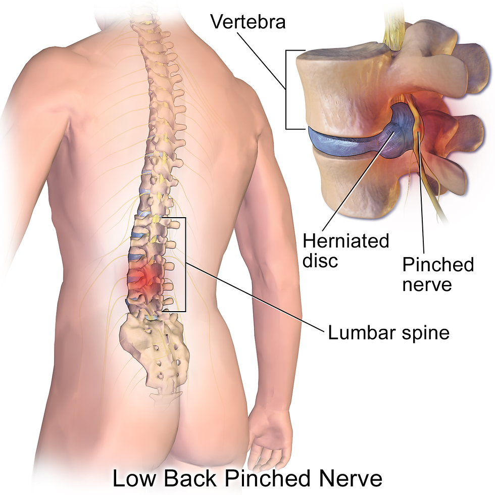 Herniated disc. Image obtained from:  Blausen.com staff (2014). "Medical gallery of Blausen Medical 2014". WikiJournal of Medicine 1 (2). DOI:10.15347/wjm/2014.010. ISSN 2002-4436. (Own work) [CC BY 3.0 (http://creativecommons.org/licenses/by/3.0)], via Wikimedia Commons