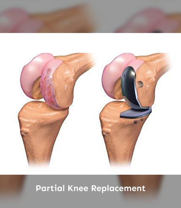 Partial Knee Replacement.png