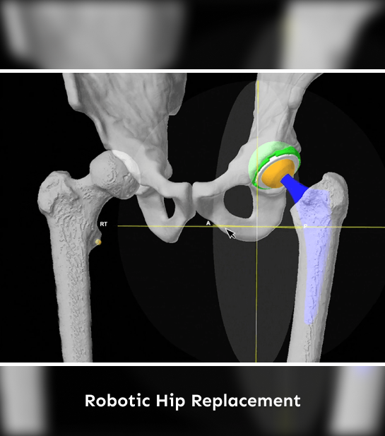 Robotic Hip Replacement.png