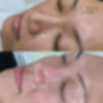 k-skin-rejuvaderm-facial-before-after25