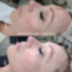 k-skin-rejuvaderm-facial-before-after16