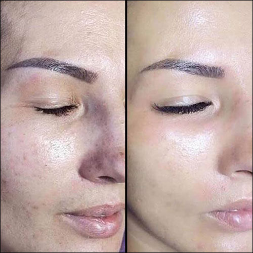 BB GLOW MICRONEEDLING