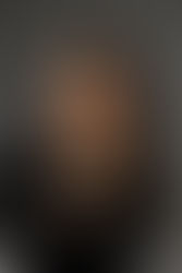 O milagre aconteceu: blefaroplastia sem bisturi!