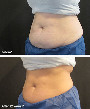 Belly fat before and after CoolSculpting